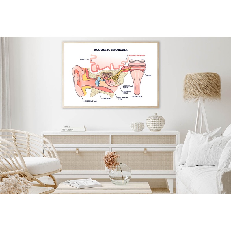 Acoustic Neuroma Home Decor Premium Quality Poster Print Choose Your Sizes