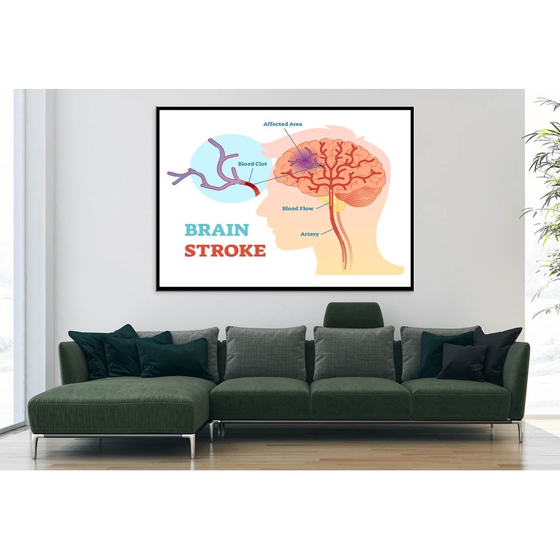 Brain Stroke Anatomical Vector Diagram Home Decor Premium Quality Poster Print Choose Your Sizes