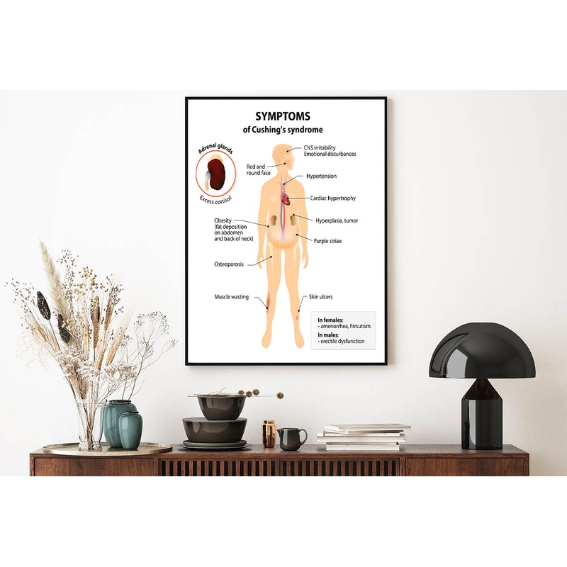 Cushings Disease and Syndrome Illustration Home Decor Premium Quality Poster Print Choose Your Sizes