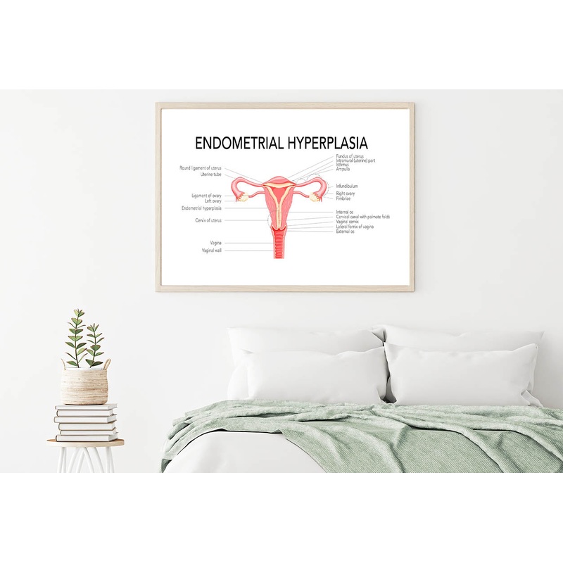 Endometrial Hyperplasia, Medical Diagram Home Decor Premium Quality Poster Print Choose Your Sizes