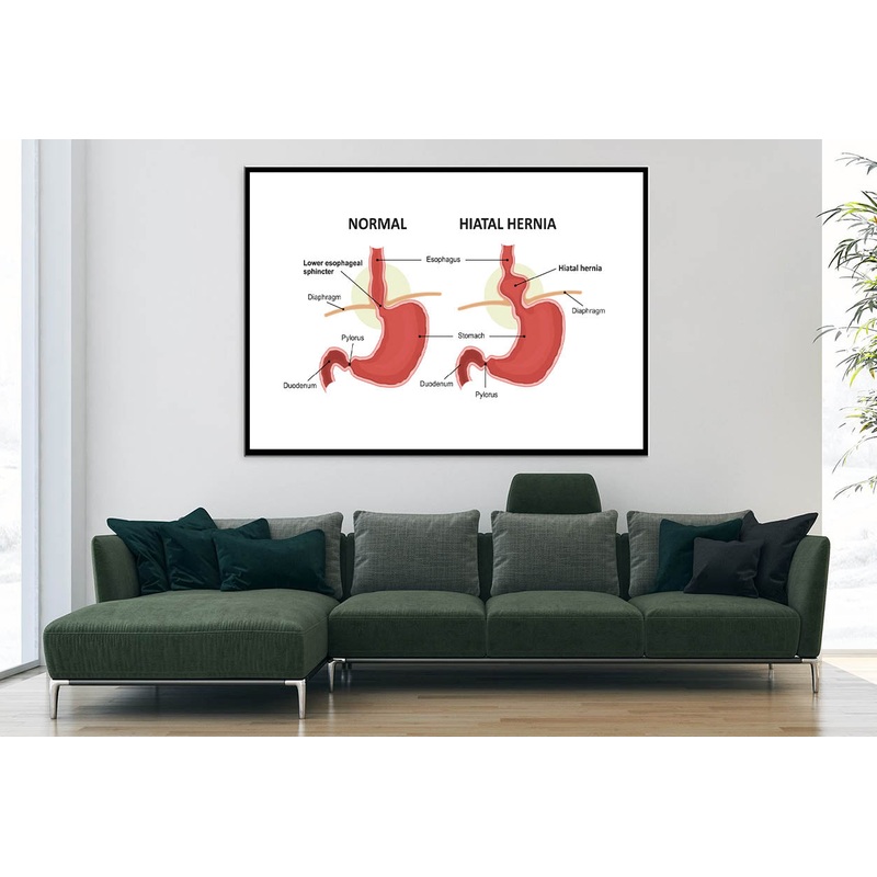 Hiatal Hernia & Normal Anatomy of The Stomach Home Decor Premium Quality Poster Print Choose Your Sizes