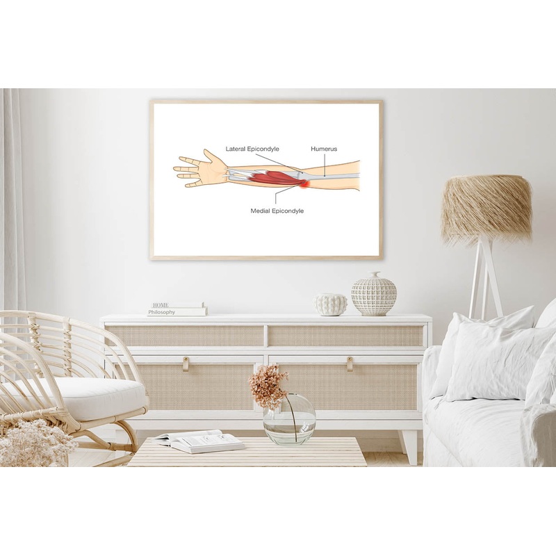 Muscle Injury and Tear in Tendon at Elbow Area Home Decor Premium Quality Poster Print Choose Your Sizes