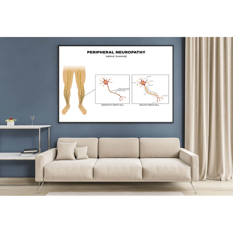Neuropathy, Nerve Damage Illustration Home Decor Premium Quality Poster Print Choose Your Sizes