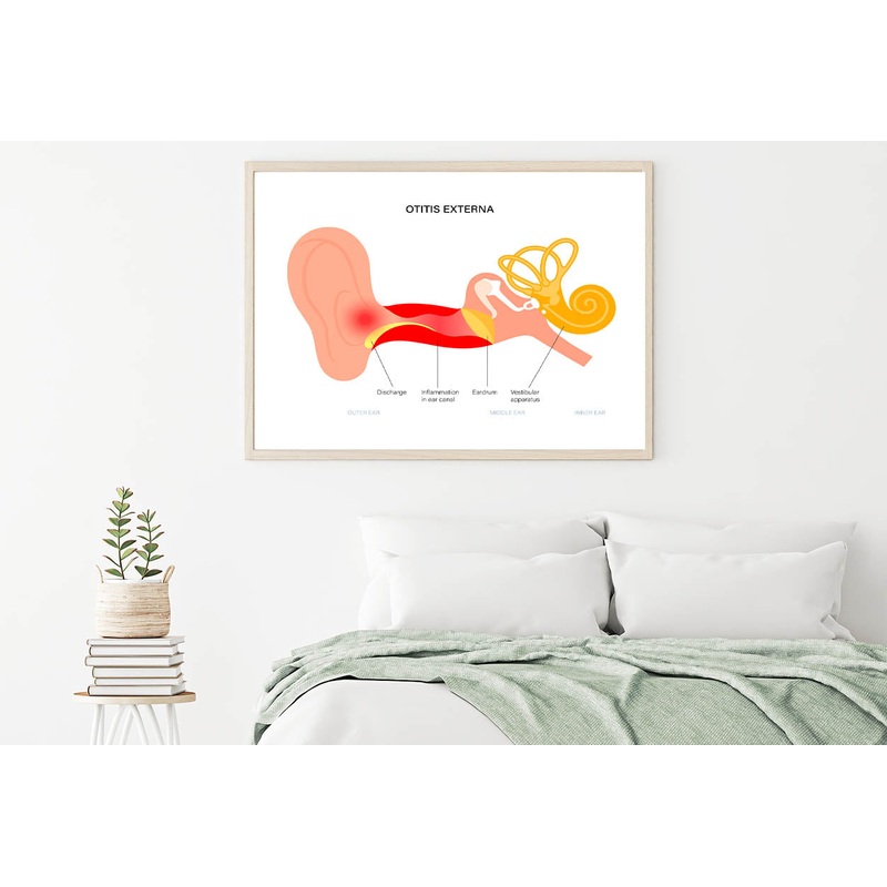 Swimmers Ear Otitis Illustration Home Decor Premium Quality Poster Print Choose Your Sizes