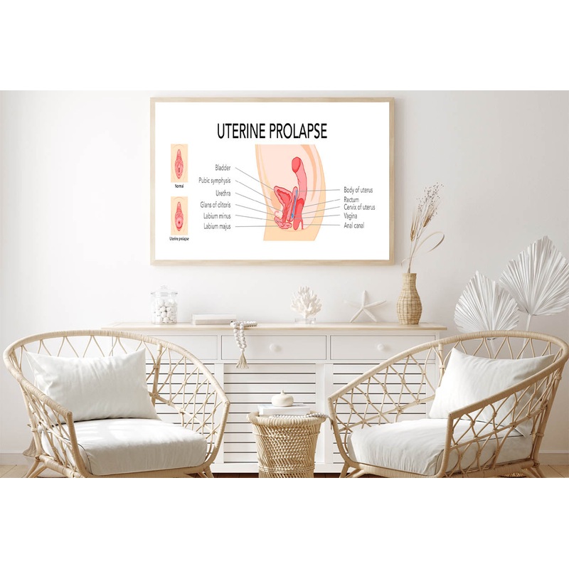 Uterine Prolapse Female Reproductive System Home Decor Premium Quality Poster Print Choose Your Sizes
